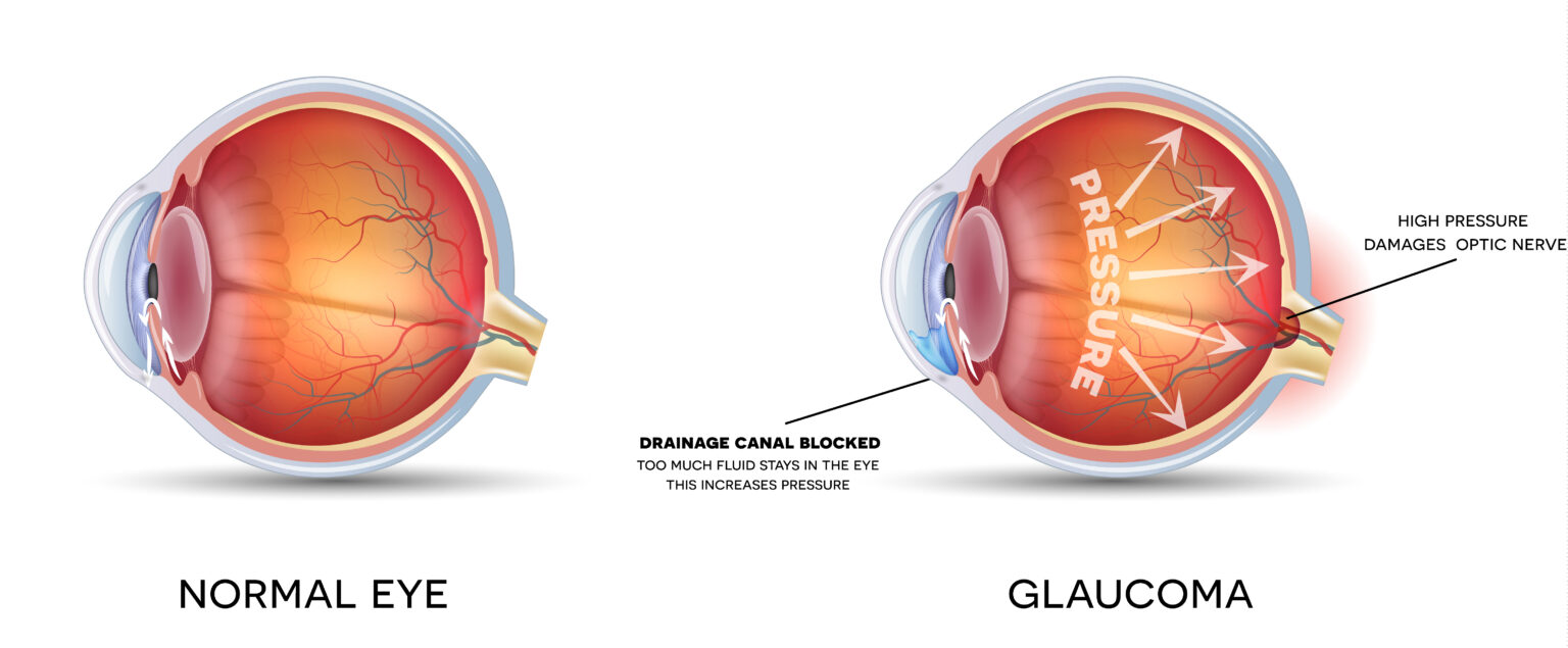 Diagram showing pressure of Glaucoma can put on the inside of eyes